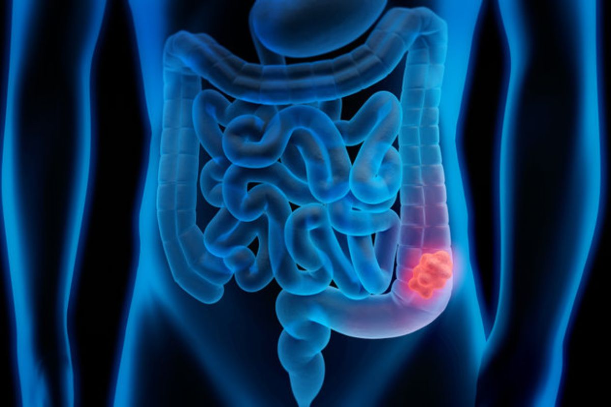 Early screening for colorectal cancer can save lives, experts say